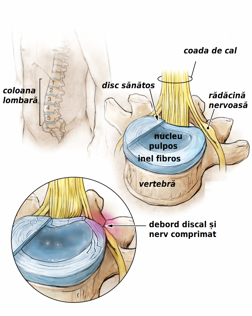 discul intervertebral cervical durere severă de spate în stânga